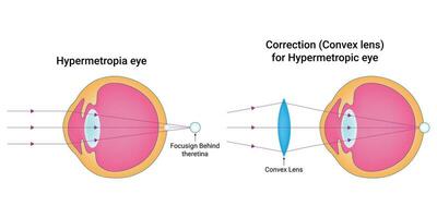 Hypermetropia eye Science Design Vector Illustration Diagram