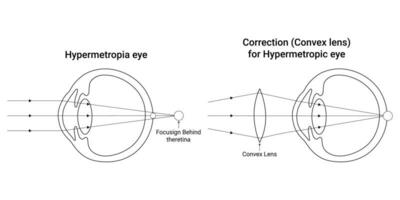 hipermetropía ojo Ciencias diseño vector ilustración diagrama