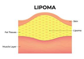 lipoma Ciencias diseño vector ilustración diagrama