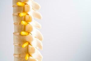Lumbar spine displaced herniated disc fragment, spinal nerve and bone. Model for treatment medical in the orthopedic department. photo