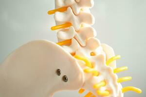 Lumbar spine displaced herniated disc fragment, spinal nerve and bone. Model for treatment medical in the orthopedic department. photo