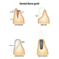 Dental Bone Graft Science Design Vector Illustration