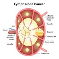 linfa nodo cáncer Ciencias diseño vector ilustración