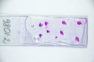 Slices of the tumor under glass. Histological examination of tumor cells for the presence of cancer photo