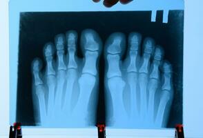 X-ray of toes. Foot on Xray. bone research photo