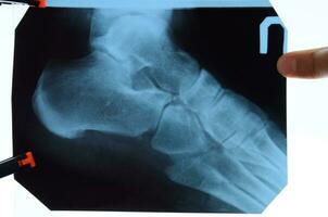 radiografía de pies y tacón huesos. X rayo imagen de huesos. foto