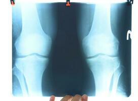 radiografía de el rodilla articulaciones, un imagen de el huesos de el rodilla en el radiografía. foto