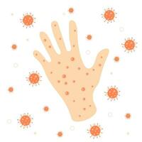 Acne on the hand with virus isolated on white background vector