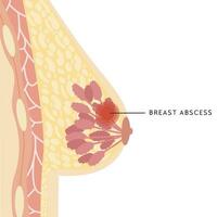 Medical Infographic Cross Section of Female Breast with Abscess. Information card with pus filled lump. Anatomy of Woman Chest with Infection. Inflammation of Mammary gland. Pain. Vector illustration.