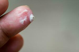 Closeup white warts bulging out from fingertips. Treatment of skin diseases with drugs used topically. Empty space for enter text. photo