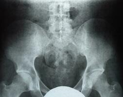 X-ray of the pelvis and sacrum. X-ray photo
