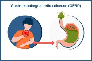 Medical vector illustration in flat style. Health care concept from acid reflux disease. Illustration of a human stomach filled with gas and a man in stomach and throat pain caused by acid reflux.