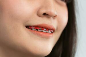 Asian woman braces. Teeth braces on the white teeth of women to equalize the teeth. Bracket system in smiling mouth, close up photo teeth, macro shot, dentist health concept.