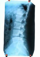 X ray of the lumbar spine, spine on x-ray photo