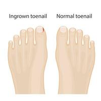 illustration of healthy feet, feet with ingrown toenails, treatment of ingrown toe and toe vector