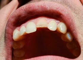 Broken tooth. Broken upper incisor in a man mouth. photo