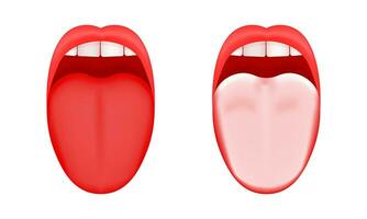 Normal and coated tongue. Dry mouth disease. Open human taste organ healthy and with symptoms of stomatitis, candidiasis or glossitis bacterial infection vector