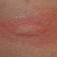 Allergy skin. Allergic reactions on the skin in the form of swelling and redness photo