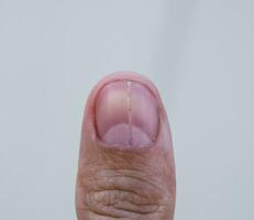 Forked nail on the thumb. Dilation of the nail, traumatic pathol photo