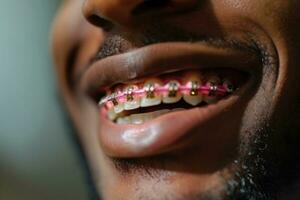 ai generado africano americano persona con tirantes sonriente. el concepto de moderno odontología. generativo ai foto