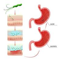 gastritis y úlcera desarrollo proceso en estómago vector