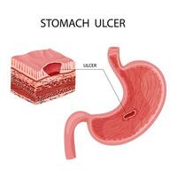 Peptic ulcer in stomach illustration vector
