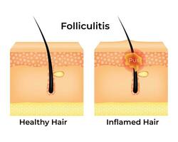 foliculitis Ciencias diseño vector ilustración diagrama