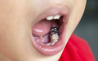 Child milk teeth fall out from gum. little boy permanent tooth grows in mouth. Cute kid open her mouth show Dental Crown and gums. Concept of health, dentist, hygiene, medical, Healthy teeth, clinic. photo