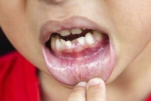 Child milk teeth fall out from gum. little boy permanent tooth grows in mouth. Cute kid open her mouth show teeth and gums. Concept of health, dentist, hygiene, medical, Healthy teeth, dental clinic. photo