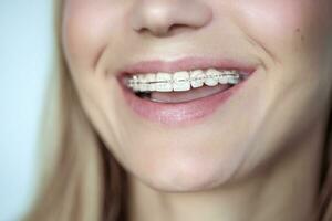 Braces, treatment for a crooked teeth photo