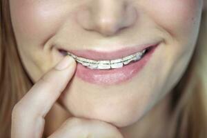 Teenager with braces photo