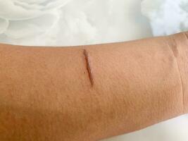 top view of burns wound on hand skin make stright line shape photo