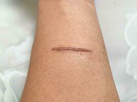 top view of burns wound on hand skin make stright line shape photo