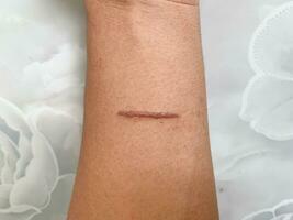 top view of burns wound on hand skin make stright line shape photo