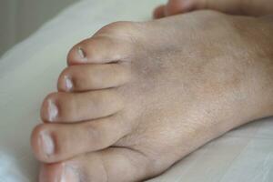 close up of women feet with swelling photo