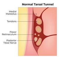 Normal Tarsal Tunnel Science Design Vector Illustration