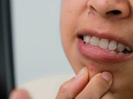 Close up of young woman squeezing pimples on her face. Problematic skin in dark-haired asian woman. Concept of skin problems and skin care. photo