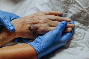 A bruise on the hand of an elderly person. Known as senile purpura. Caused by the fragility of the skin and blood vessels in old age. Elderly care photo