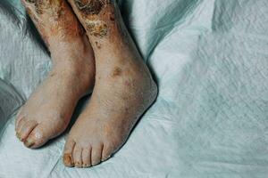 Legs of an elderly woman with varicose veins, scabbed wounds, varicose veins and thrombosis, elderly person not walking, close-up, phlebitis, thrombosis photo