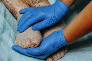 On the legs of an elderly woman, the skin peels off due to eczema, swelling of the legs. Yellowing of the nail plate. Swelling of the legs. Consequences of diabetes in the elderly. Elderly care photo