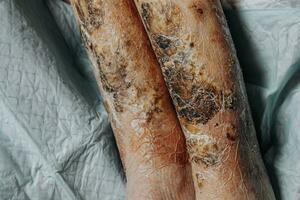 Skin lesions on the leg. Symptoms characteristic of the elderly begin with a red rash in a small circle and spread to a wider area. Large scabs on the legs. Elderly care. Consequences of diabetes photo