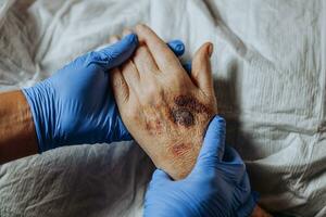 A bruise on the hand of an elderly person. Known as senile purpura. Caused by the fragility of the skin and blood vessels in old age. Elderly care photo