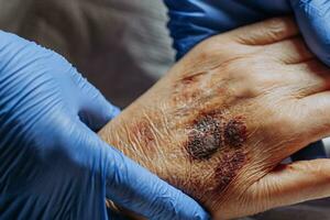 A bruise on the hand of an elderly person. Known as senile purpura. Caused by the fragility of the skin and blood vessels in old age. Elderly care photo