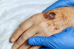 A bruise on the hand of an elderly person. Known as senile purpura. Caused by the fragility of the skin and blood vessels in old age. Elderly care photo