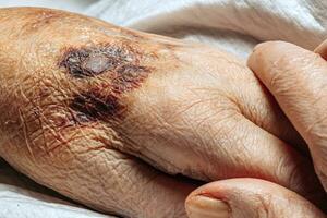 un moretón en el mano de un mayor persona. conocido como senil púrpura. causado por el fragilidad de el piel y sangre vasos en antiguo edad. mayor cuidado foto