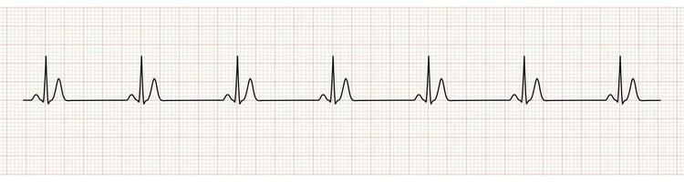 EKG Monitor Showing  Sinus Rhythm with Short QT interval vector