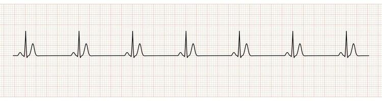 ekg monitor demostración seno ritmo con corto qt intervalo vector