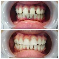 Before and after fixation for huge gap between front teeth or incisors, diastema. photo