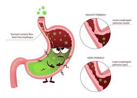 Gastroesophageal reflux disease GERD diagram with sad cartoon stomach character vector