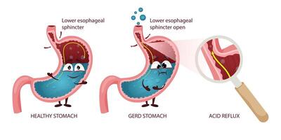 Cute healthy and GERD stomach cartoon characters with faces and emotions vector